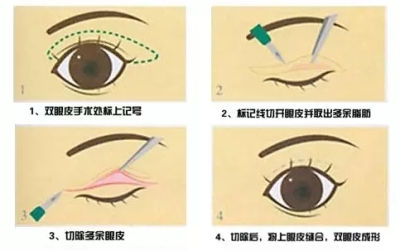 双眼皮